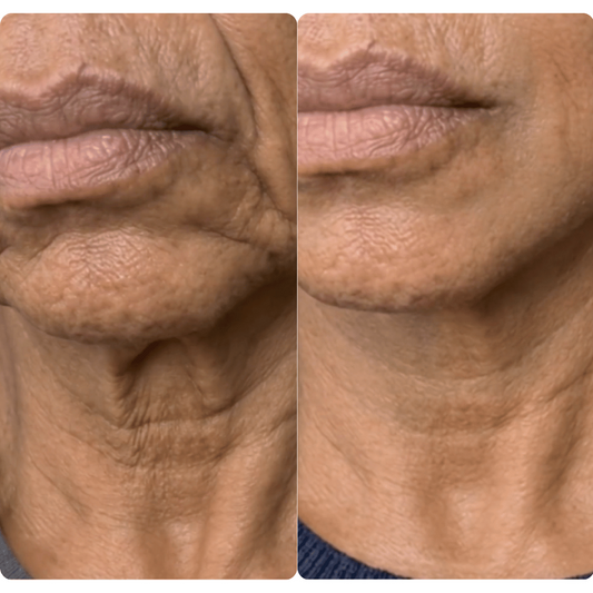 Navaro™ Collagen Lifting Ampoule