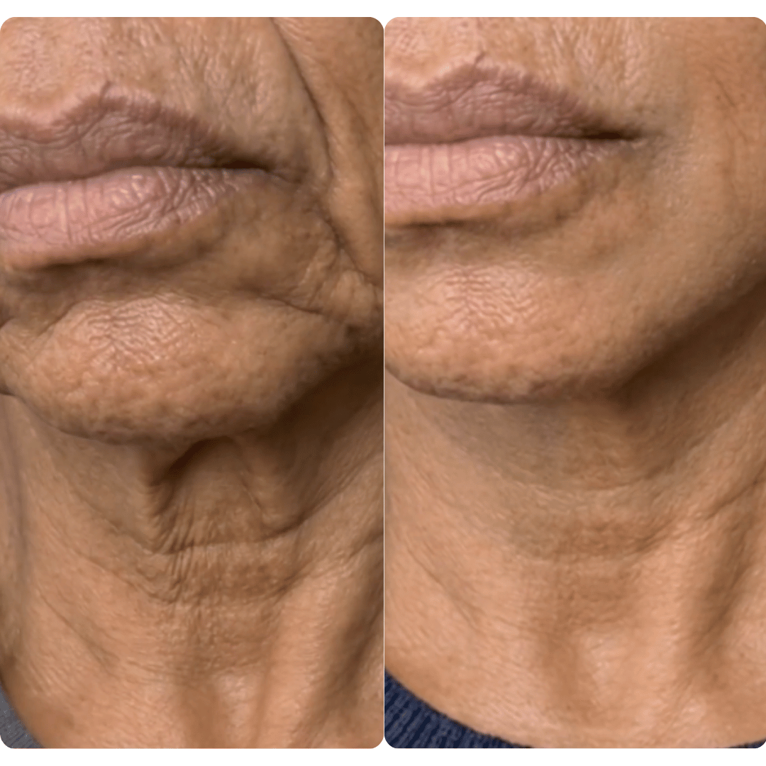 Navaro™ Collagen Lifting Ampoule